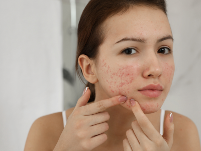 acne treatment in mumbai