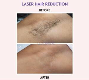 laser hair reduction