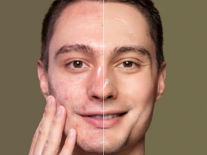 pigmentation treatment in Santacruz.