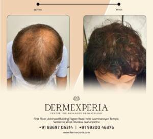 hair regrowth treatment in santacruz