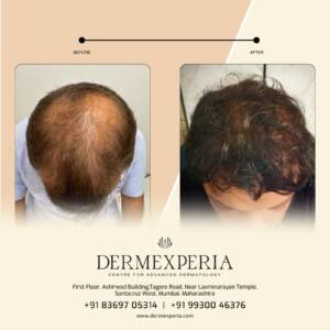 Hair transplant treatment in Santacruz,