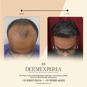 Hair transplant treatment in Santacruz,