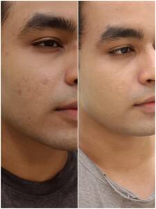 acne scar treatment in santacruz