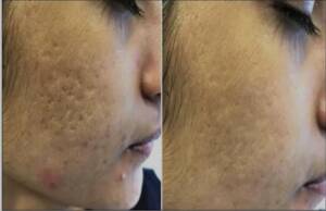 acne scar treatment in santacruz