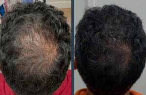 hair regrowth treatment in santacruz