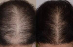 hair regrowth treatment in santacruz