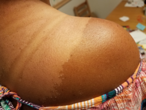 Suntan Treatment in Santacruz