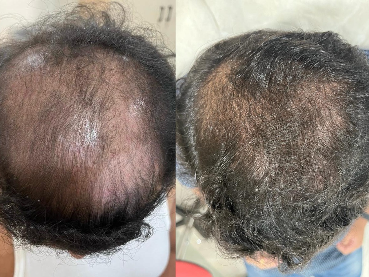 Hair Transplant