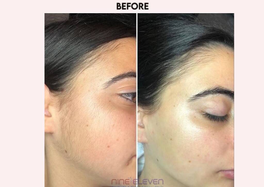 laser hair reduction treatment