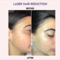 Laser Hair Reduction in Santacruz