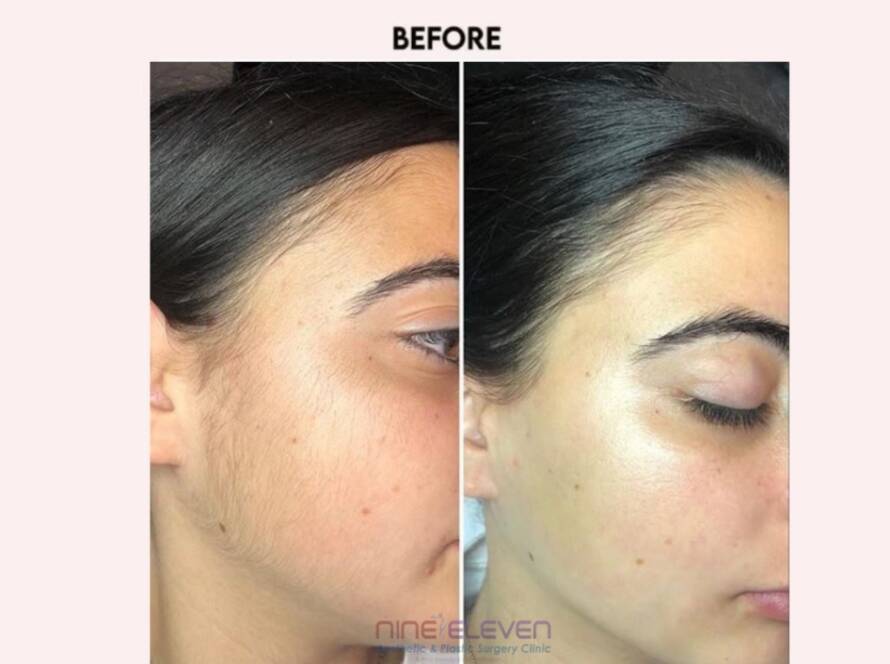 laser hair reduction treatment