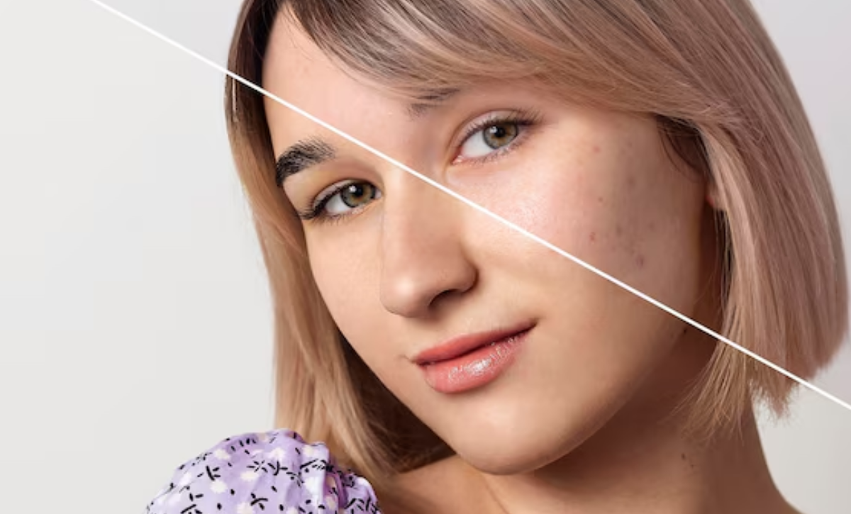 How to Achieve Flawless Skin with Pigmentation Treatment in Santacruz