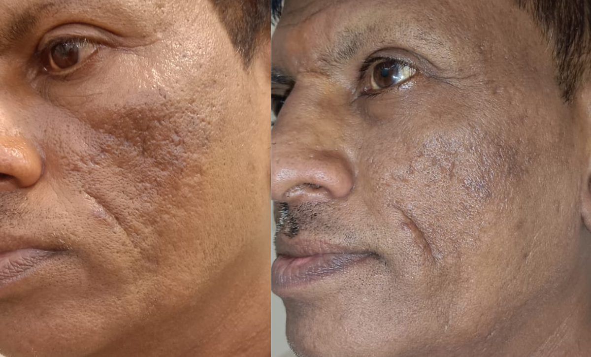acne scar treatment in santacruz