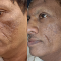 The new gold standard therapy for acne scars treatment in Santacruz