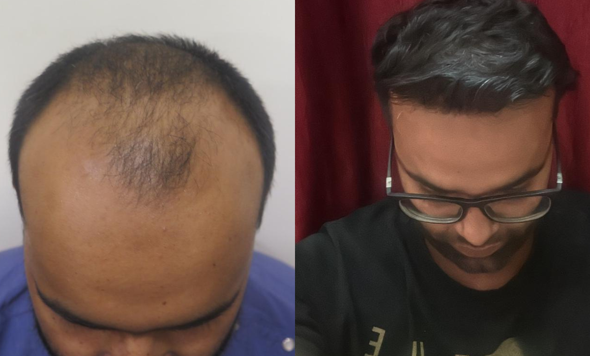 Hair Transplant Treatment in Santacruz