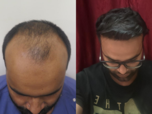 Hair Transplant Treatment in Santacruz