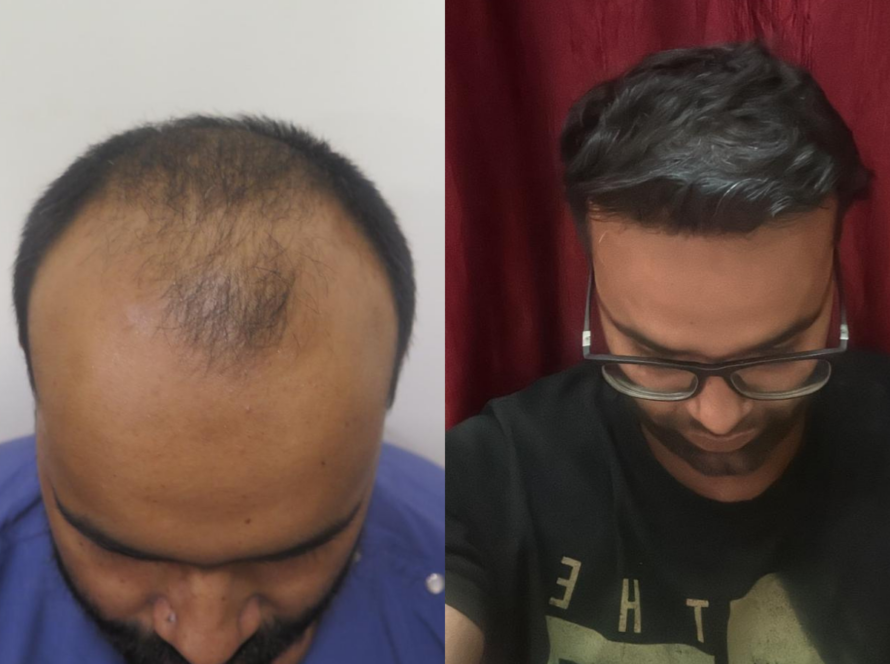 Hair Transplant Treatment in Santacruz