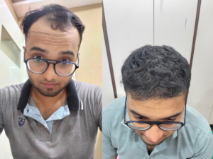 Hair Transplant Treatment in Santacruz