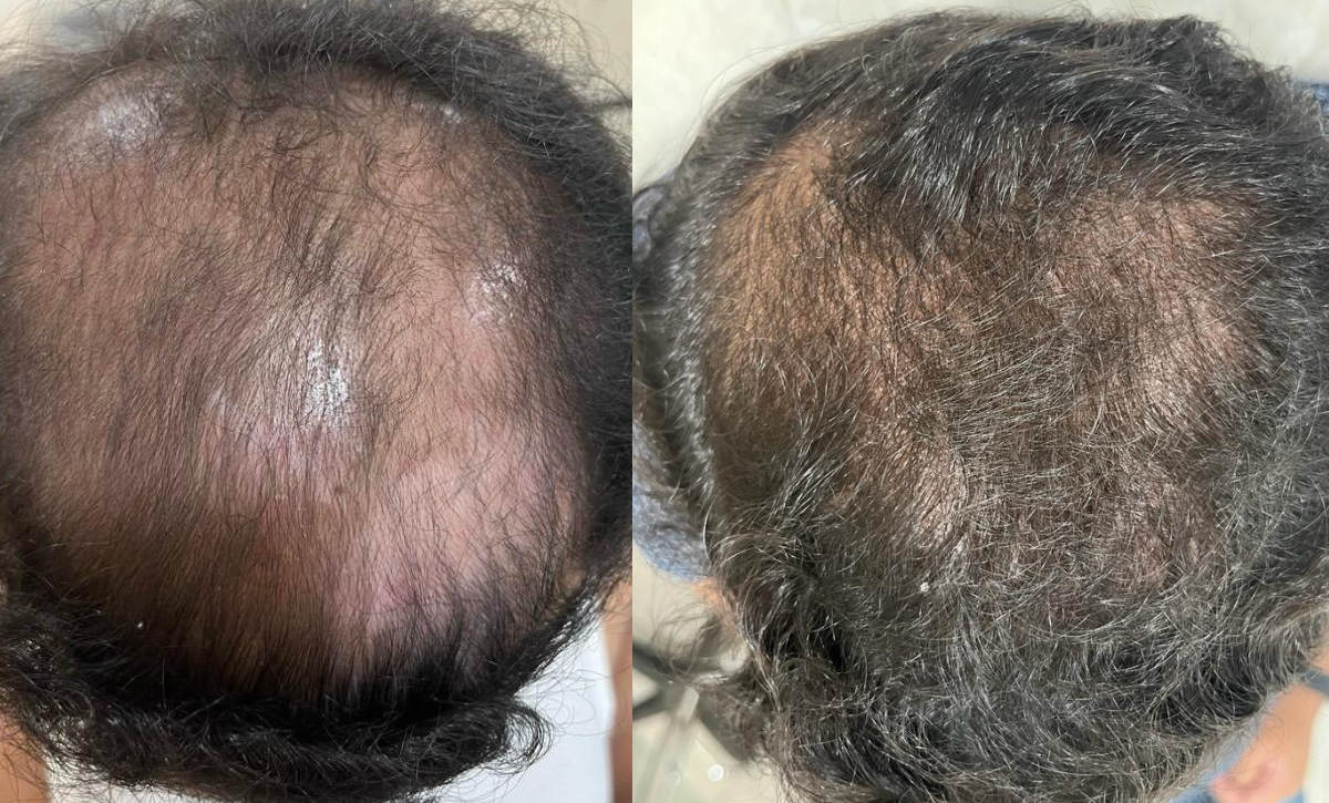 Hair Transplant Treatment in Santacruz
