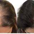 Exosomes for Hair Regrowth in Santacruz: A Revolutionary Approach at Dermexperia