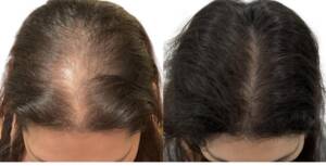 hair regrowth treatment in santacruz