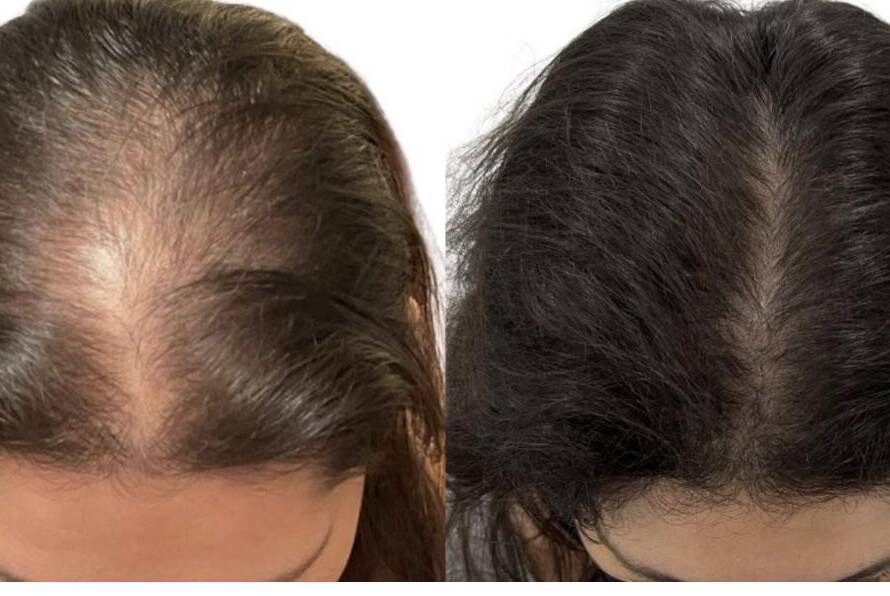 hair regrowth treatment in santacruz