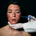 Experience the Best Vampire Facial at Dermexperia: Benefits and What to Expect