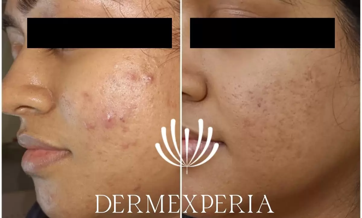 Best Acne Scar Treatments in Mumbai