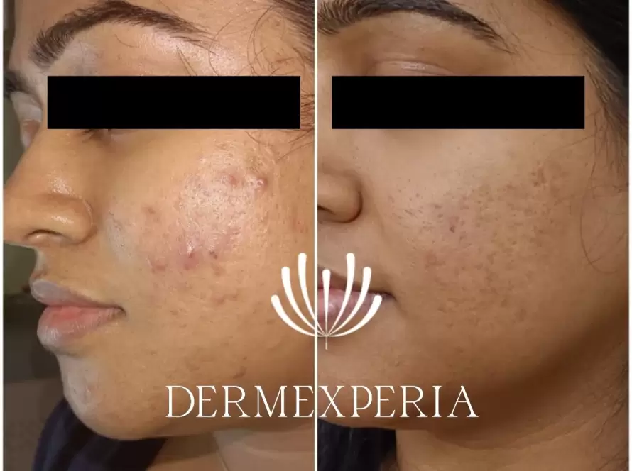 Best Acne Scar Treatments in Mumbai