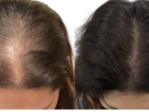 Exosome Hair Treatment in Santacruz