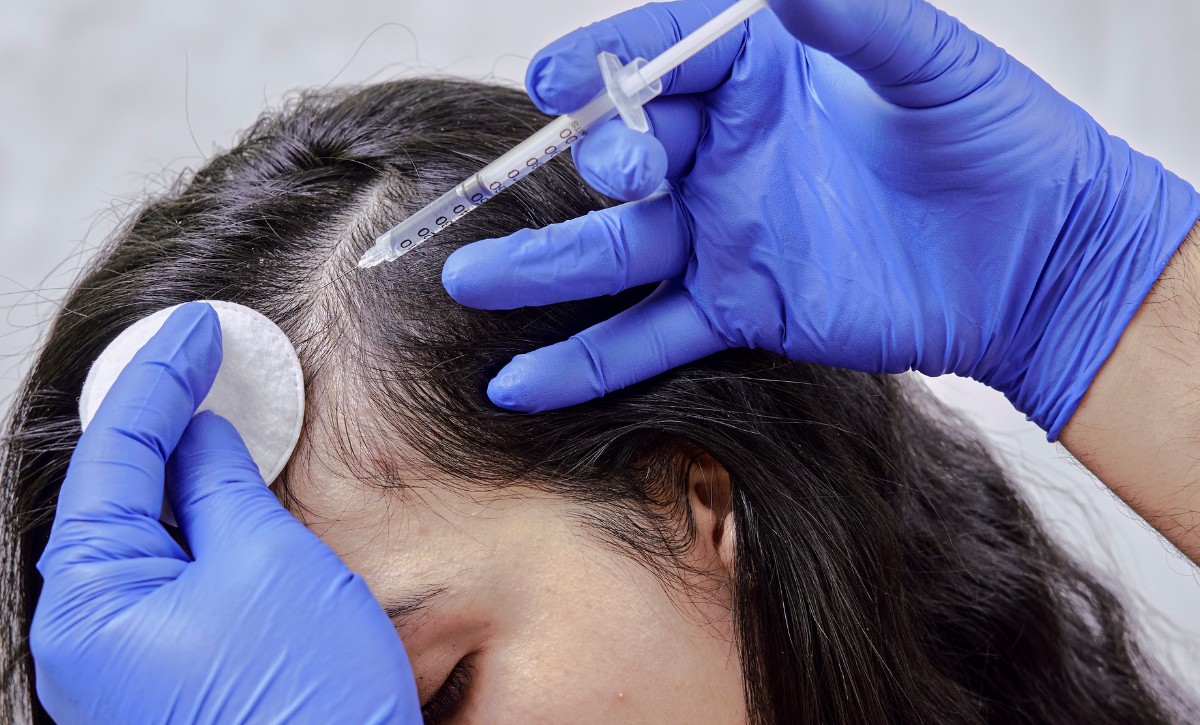 Exosome Hair Treatment in Santacruz