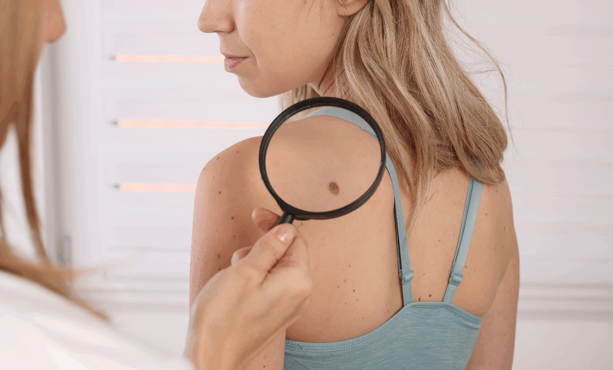 Skin Tag Removal in Santacruz