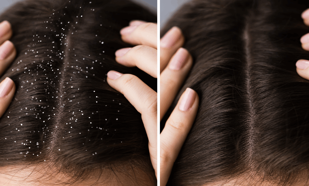 Scalp Psoriasis Treatment in Santacruz
