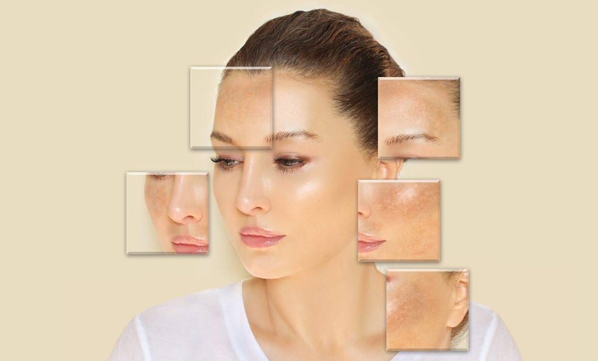 Skin Pigmentation Treatment in Mumbai