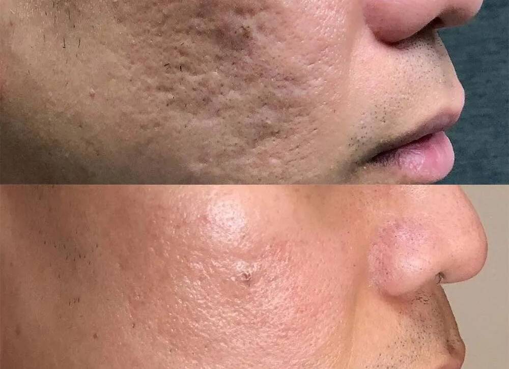 Scar Removal Treatment in Mumbai