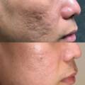 Scar Removal Treatment in Mumbai: Best Options Available