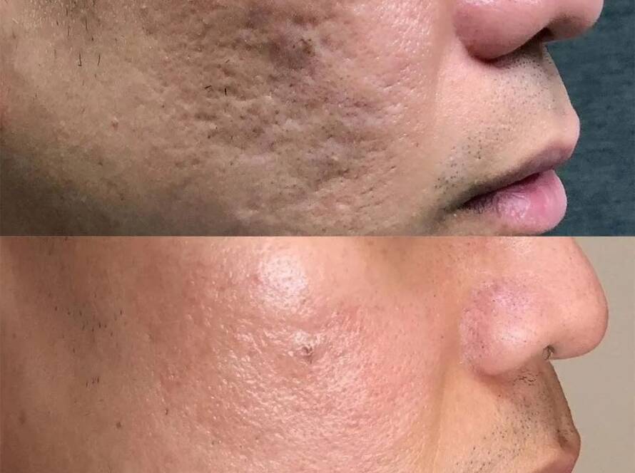 Scar Removal Treatment in Mumbai