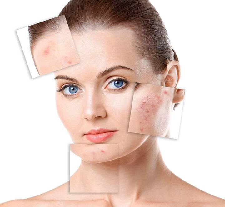 Best Dermatologist for Acne in Mumbai