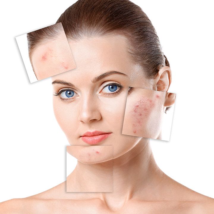 Best Dermatologist for Acne in Mumbai