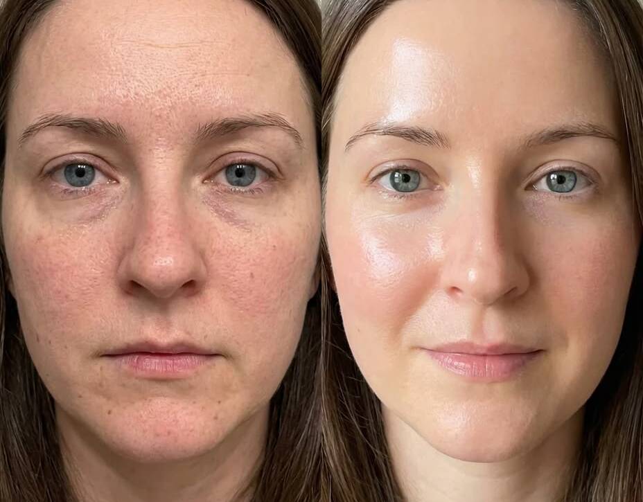 Pigmentation Removal Treatment