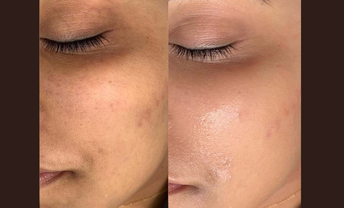 Acne Treatment in Mumbai