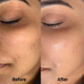 Acne Treatment in Mumbai: Expert Dermatological Care at Dermexperia