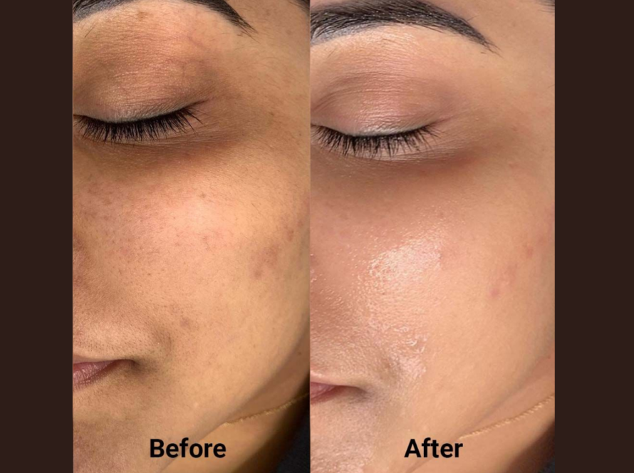Acne Treatment in Mumbai