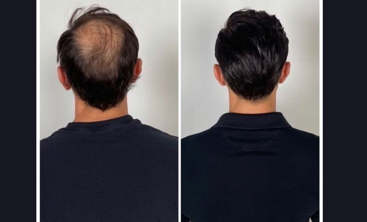 Hair Transplant Cost Per Graft Mumbai