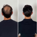 Hair Transplant Cost Per Graft in Mumbai: Everything You Need to Know